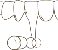 A line drawing illustrating the process of a apicoectomy