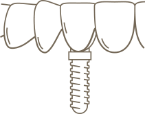 a line drawing illustrating the post, abutement, and crown of a dental implant
