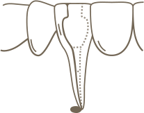 A line drawing of lower teeth with an x-ray outline of the areas of the tooth involved in endodontic retreatment