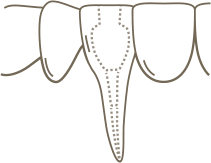 A line drawing of the lower teeth showing an x-ray outline of the tooth pulp and roots.